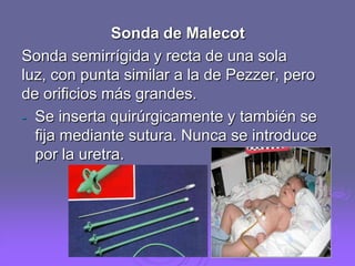 Sonda de Malecot
Sonda semirrígida y recta de una sola
luz, con punta similar a la de Pezzer, pero
de orificios más grandes.
- Se inserta quirúrgicamente y también se
fija mediante sutura. Nunca se introduce
por la uretra.

 