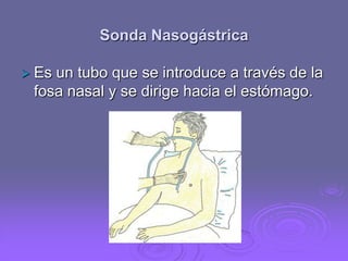 Sonda Nasogástrica
 Es

un tubo que se introduce a través de la
fosa nasal y se dirige hacia el estómago.

 