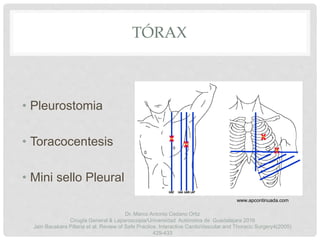 TÓRAX
• Pleurostomia
• Toracocentesis
• Mini sello Pleural
www.apcontinuada.com
Dr. Marco Antonio Cedano Ortiz
Cirugía General & Laparoscopia/Universidad Autónoma de Guadalajara 2016
Jain Bauskara Pillaria et al. Review of Safe Practice. Interactive CardioVascular and Thoracic Surgery4(2005)
429-433
 