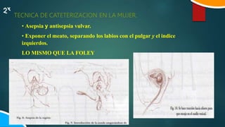 TECNICA DE CATETERIZACION EN LA MUJER.
• Asepsia y antisepsia vulvar.
• Exponer el meato, separando los labios con el pulgar y el indice
izquierdos.
LO MISMO QUE LA FOLEY
 
