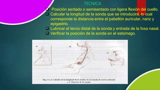 TECNICA
 Posición sentado o semisentado con ligera flexión del cuello.
 Calcular la longitud de la sonda que se introducirá, lo cual
corresponde la distancia entre el pabellón auricular, nariz y
epigastrio.
 Lubricar el tercio distal de la sonda y entrada de la fosa nasal.
 Verificar la posición de la sonda en el estomago.
 