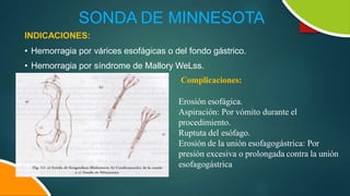 SONDA DE MINNESOTA
INDICACIONES:
• Hemorragia por várices esofágicas o del fondo gástrico.
• Hemorragia por síndrome de Mallory WeLss.
Complicaciones:
Erosión esofágica.
Aspiración: Por vómito durante el
procedimiento.
Ruptuta del esófago.
Erosión de la unión esofagogástrica: Por
presión excesiva o prolongada contra la unión
esofagogástrica
 