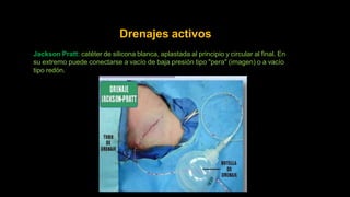 Drenajes activos
Jackson Pratt: catéter de silicona blanca, aplastada al principio y circular al final. En
su extremo puede conectarse a vacío de baja presión tipo "pera" (imagen) o a vacío
tipo redón.
 
