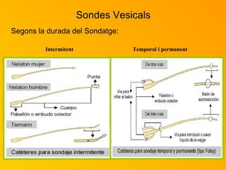 Sondes Vesicals Segons la durada del Sondatge: Intermitent Temporal i permanent 