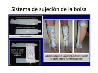 Sistema de sujeción de la bolsa
 