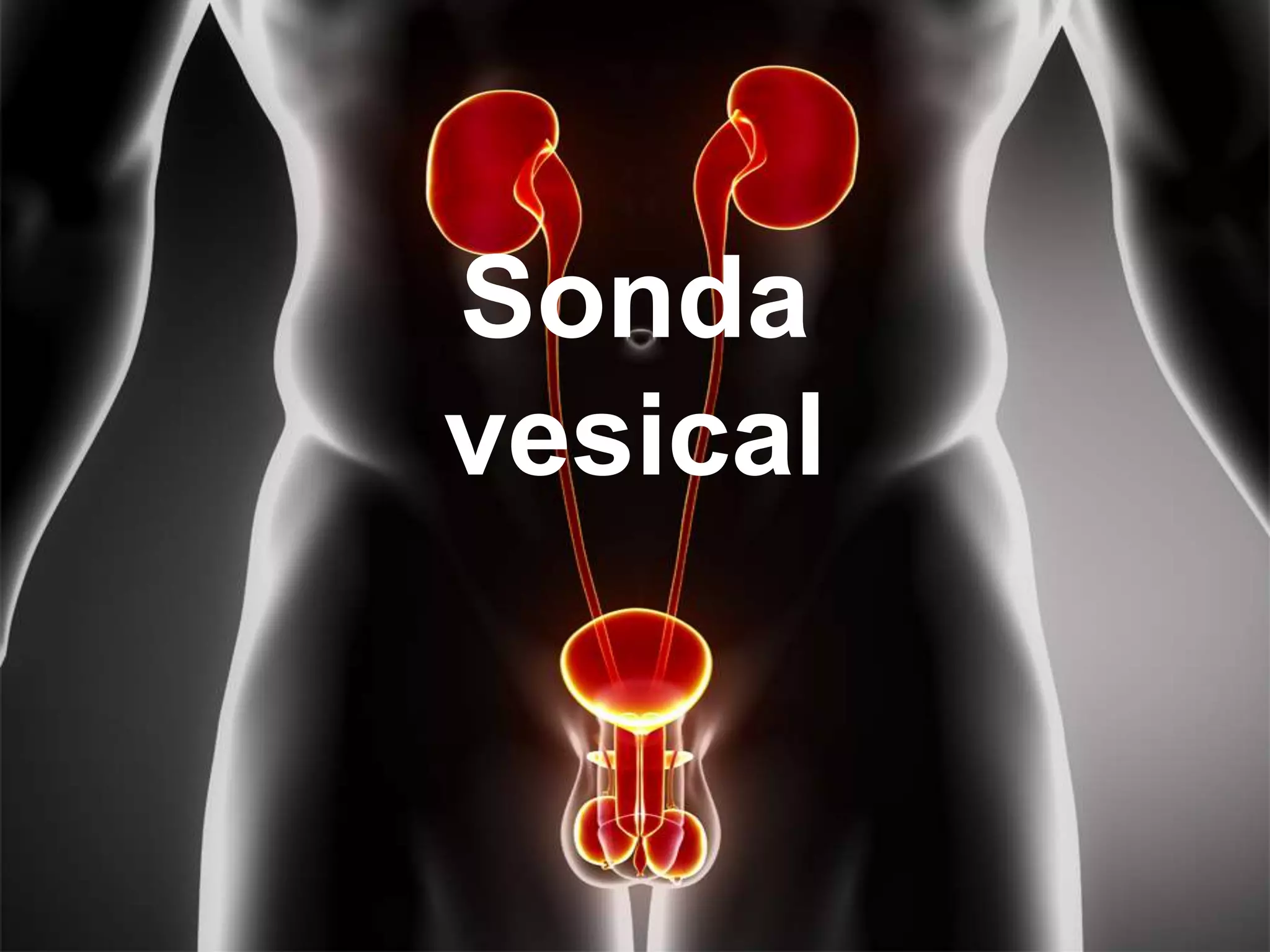 Sonda
vesical