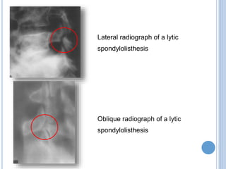 Lateral radiograph of a lytic
spondylolisthesis
Oblique radiograph of a lytic
spondylolisthesis
 