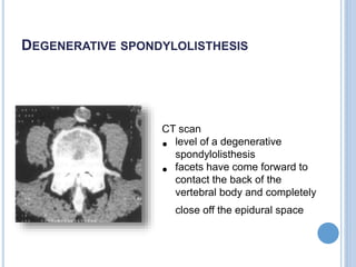 CT scan
• level of a degenerative
spondylolisthesis
• facets have come forward to
contact the back of the
vertebral body and completely
close off the epidural space
DEGENERATIVE SPONDYLOLISTHESIS
 