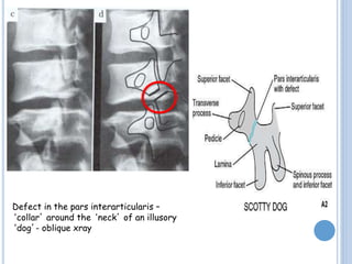 Defect in the pars interarticularis –
‘collar’ around the ‘neck’ of an illusory
‘dog’- oblique xray
 