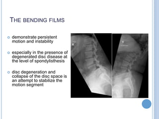 THE BENDING FILMS
 demonstrate persistent
motion and instability
 especially in the presence of
degenerated disc disease at
the level of spondylisthesis
 disc degeneration and
collapse of the disc space is
an attempt to stabilize the
motion segment
 