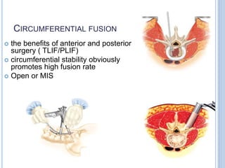 CIRCUMFERENTIAL FUSION
 the benefits of anterior and posterior
surgery ( TLIF/PLIF)
 circumferential stability obviously
promotes high fusion rate
 Open or MIS
 