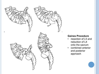 Gaines Procedure
• resection of L5 and
reduction of L4
onto the sacrum
• combined anterior
and posterior
approach
 