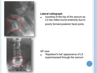 Lateral radiograph
• rounding of the top of the sacrum as
L5 has rolled round anteriorly due to
poorly formed posterior facet joints
AP view
• 'Napoleon's hat' appearance of L5
superimposed through the sacrum
 