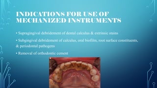INDICATIONS FOR USE OF
MECHANIZED INSTRUMENTS
• Supragingival debridement of dental calculus & extrinsic stains
• Subgingival debridement of calculus, oral biofilm, root surface constituents,
& periodontal pathogens
• Removal of orthodontic cement
 