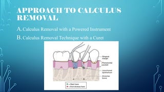 APPROACH TO CALCULUS
REMOVAL
A.Calculus Removal with a Powered Instrument
B.Calculus Removal Technique with a Curet
 