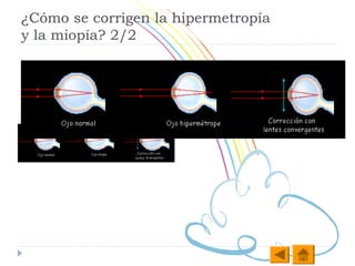 ¿Cómo se corrigen la hipermetropía
y la miopía? 2/2
 