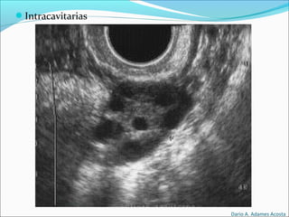 Intracavitarias
Dario A. Adames Acosta
 