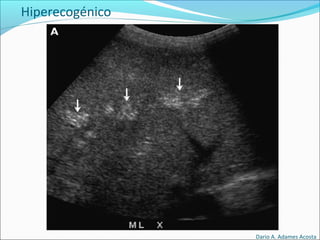 Hiperecogénico
Dario A. Adames Acosta
 