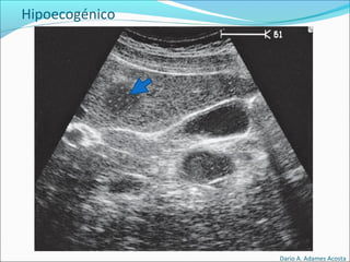 Hipoecogénico
Dario A. Adames Acosta
 