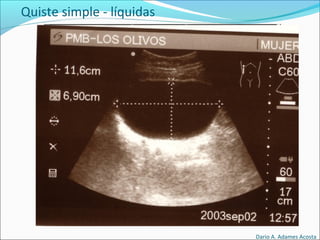 Quiste simple - líquidas
Dario A. Adames Acosta
 