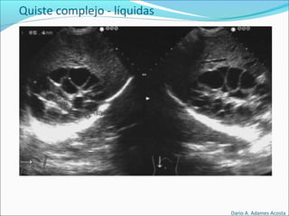 Quiste complejo - líquidas
Dario A. Adames Acosta
 