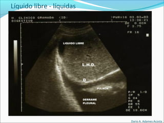 Líquido libre - líquidas
Dario A. Adames Acosta
 