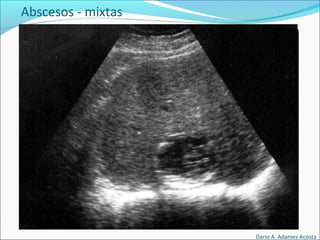 Abscesos - mixtas
Dario A. Adames Acosta
 