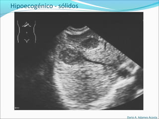 Hipoecogénico - sólidos
Dario A. Adames Acosta
 