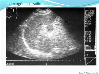 Isoecogénico - sólidas
Dario A. Adames Acosta
 