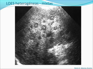 LOES heterogéneas - mixtas
Dario A. Adames Acosta
 