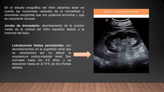 En el estudio ecográfico del riñón debemos tener en
cuenta las numerosas variantes de la normalidad y
anomalías congénitas que nos podemos encontrar y que
es importante conocer.
Lobulaciones fetales persistentes: son
abombamientos en la superficie renal que
se caracterizan por no alterar la
arquitectura cortico-medular renal. Son
normales hasta los 4-5 años, y se
descubren hasta en el 51% de los riñones
adultos.
Joroba de dromedario: abombamiento de la porción
media de la cortical del riñón izquierdo debida a la
impronta del bazo.
 