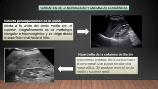 afecta a la unión del tercio medio con el
superior, ecográficamente es de morfología
triangular e hiperecogénico y se dirige desde
la superficie renal hacia el hilio.
Defecto parenquimatoso de la unión
VARIANTES DE LA NORMALIDAD Y ANOMALÍAS CONGÉNITAS
Hipertrofia de la columna de Bertín
crecimiento anómalo de la cortical hacia
el seno renal, que puede simular una
masa sólida. Se produce entre el tercio
medio y superior renal
 