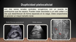 Duplicidad pielocalicial
son dos senos renales centrales, ecogénicos con un puente de
parénquima que los separa. Pueden estar asociados a un solo uréter o a
dos que desembocan de forma separada en la vejiga. Debe sospecharse
al apreciar un mayor tamaño renal.
Doble Sistema pielocalicial Doble sistema
 