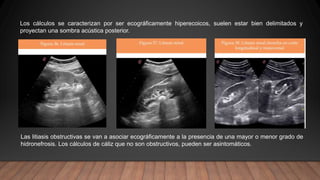Los cálculos se caracterizan por ser ecográficamente hiperecoicos, suelen estar bien delimitados y
proyectan una sombra acústica posterior.
Las litiasis obstructivas se van a asociar ecográficamente a la presencia de una mayor o menor grado de
hidronefrosis. Los cálculos de cáliz que no son obstructivos, pueden ser asintomáticos.
 