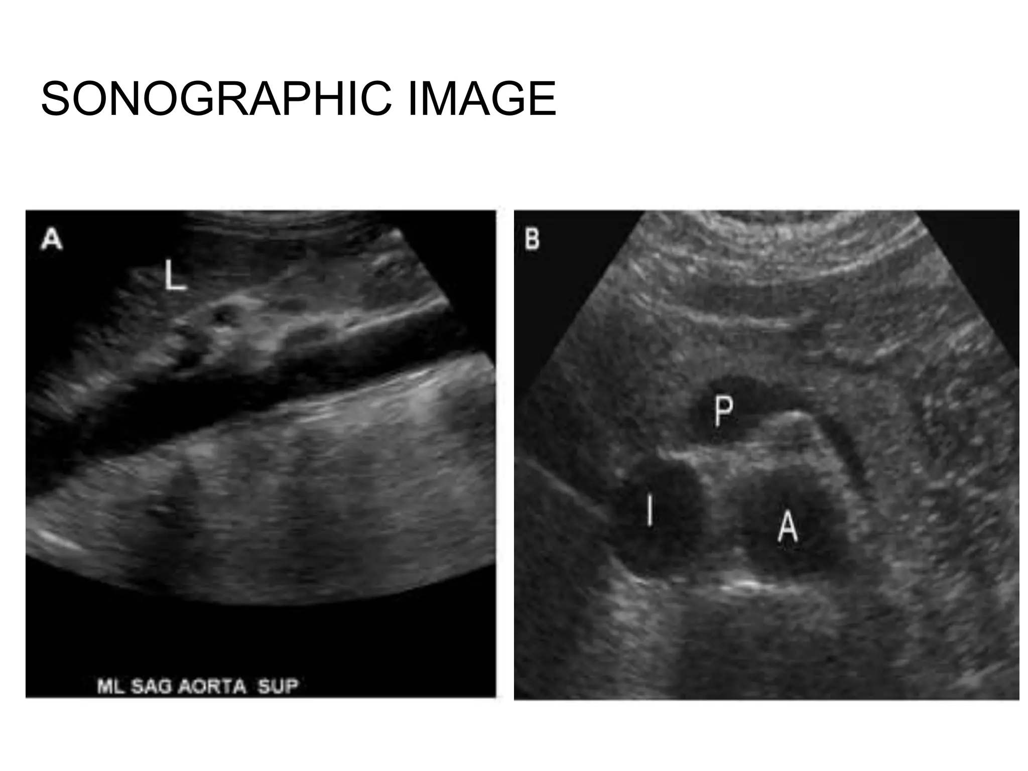 Sonographic anatomy of abdomen and pelvic organ | PPTX