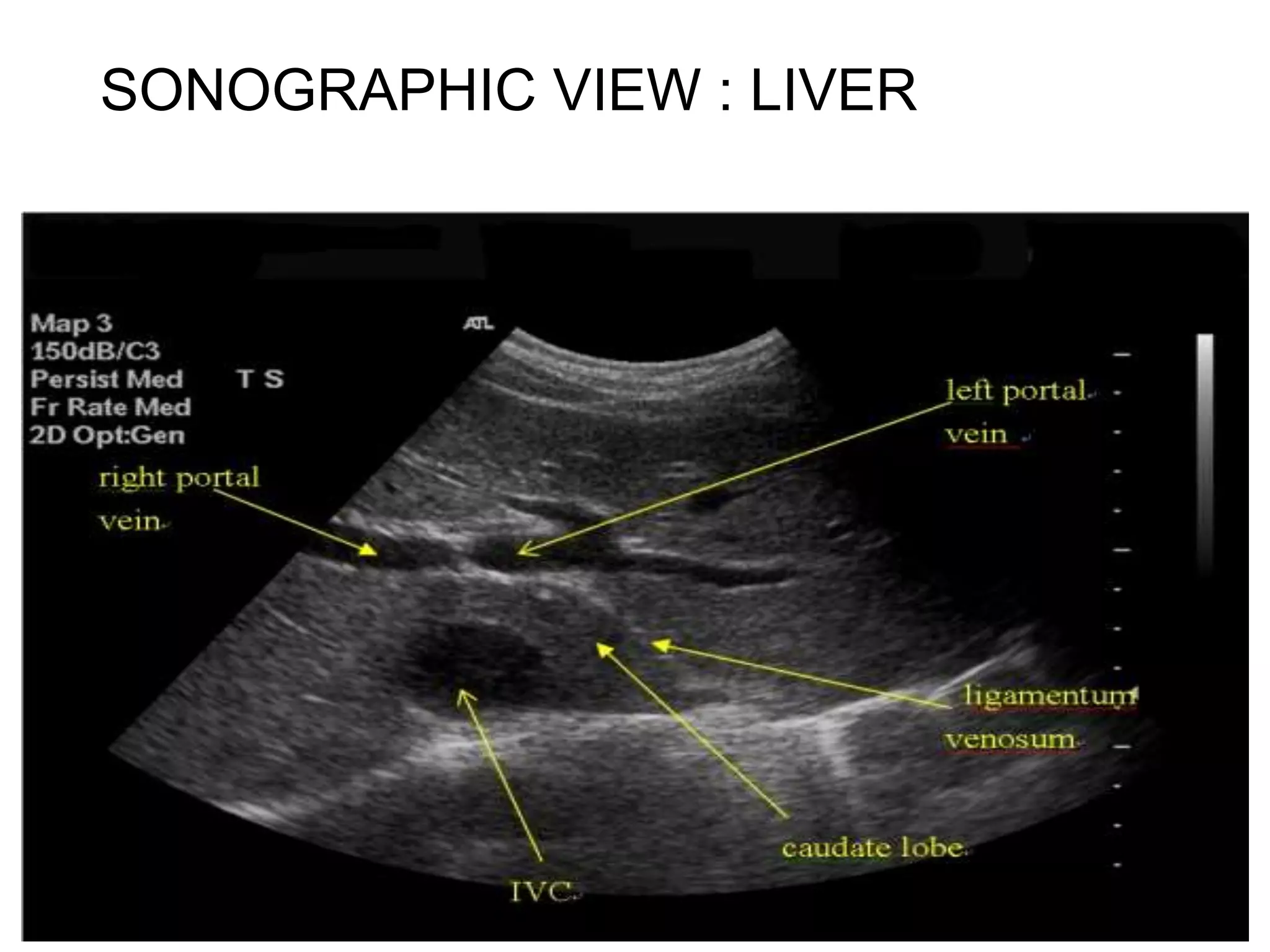 Songraphic Panel Sonographic anatomy of abdomen and pelvic organ | PPTX