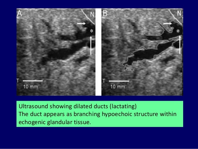 Sonographic evaluation of breast Dr. Muhammad Bin Zulfiqar