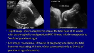 • Right image shows a transverse scan of the fetal head at 24 weeks
with brachycephalic configuration (BPD 90 mm, which co...