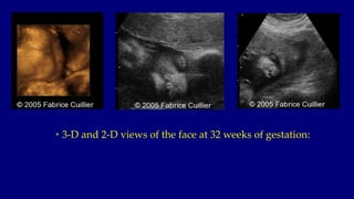 • 3-D and 2-D views of the face at 32 weeks of gestation:
 