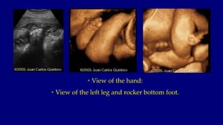 • View of the hand:
• View of the left leg and rocker bottom foot.
 