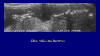 Ulna, radius and humerus
 