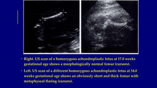 • Right. US scan of a homozygous achondroplastic fetus at 17.0 weeks
gestational age shows a morphologically normal femur ...