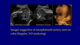 Images suggestive of encephalocele (artery seen on
color Doppler, 3-D rendering)
 