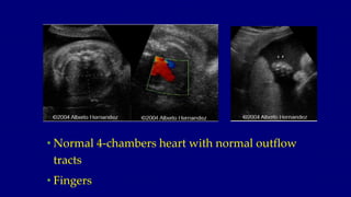 • Normal 4-chambers heart with normal outflow
tracts
• Fingers
 