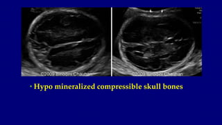 • Hypo mineralized compressible skull bones
 