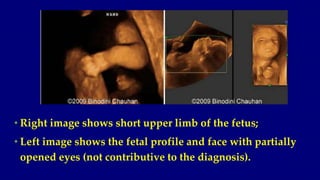• Right image shows short upper limb of the fetus;
• Left image shows the fetal profile and face with partially
opened eye...