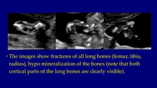 • The images show fractures of all long bones (femur, tibia,
radius), hypo mineralization of the bones (note that both
cor...