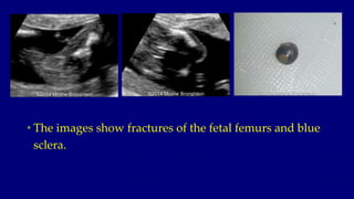 • The images show fractures of the fetal femurs and blue
sclera.
 