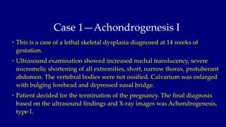 Case 1—Achondrogenesis I
• This is a case of a lethal skeletal dysplasia diagnosed at 14 weeks of
gestation.
• Ultrasound ...