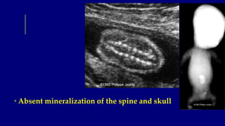 • Absent mineralization of the spine and skull
 